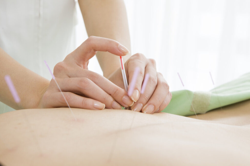 Acupuncture Treatment for Fertility